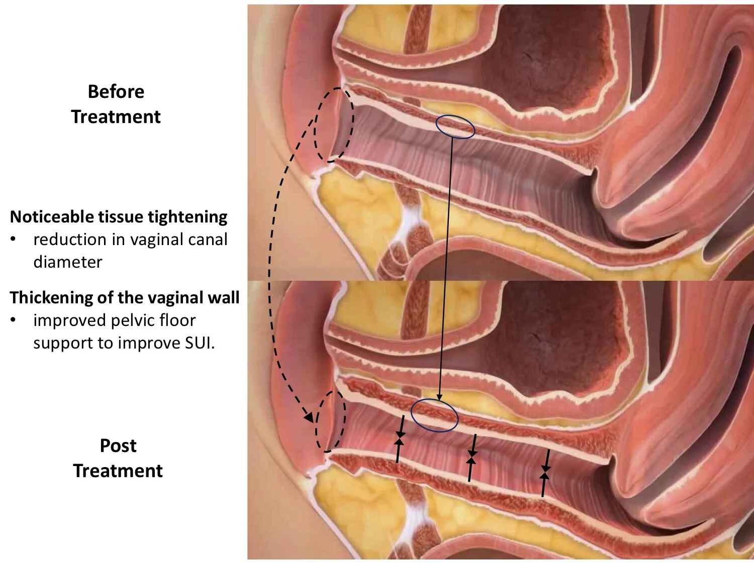 Laser Vaginal Rejuvenation Before And After