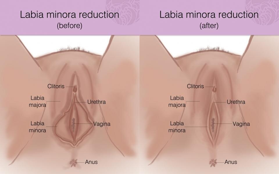 Labia Minora Surgery 