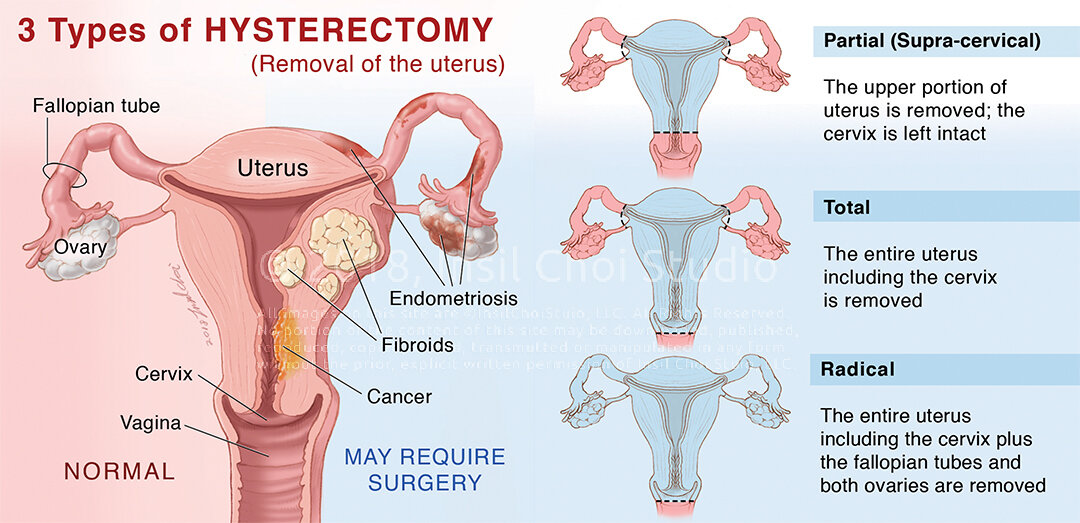 Hysterectomy