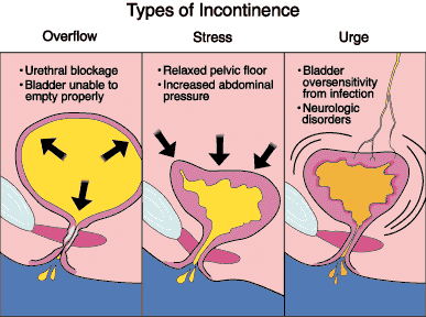 UrinaryIncontinence.gif