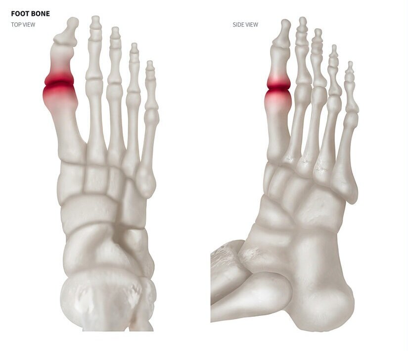 Treatment for Arthritic Big Toe Joints (Hallux Rigidus) - Perth Foot Centre