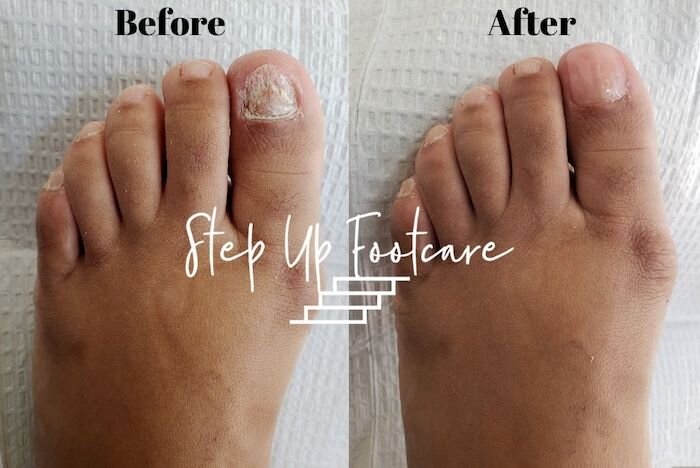 KeryFlex® Toenail Restoration Before and After Pictures