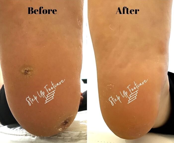 plantar wart swift microwave therapy before and after pictures