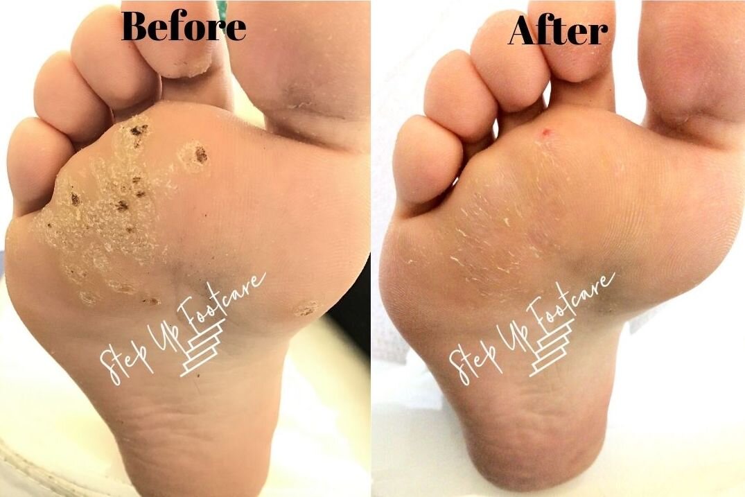 plantar wart swift microwave therapy before and after pictures 2