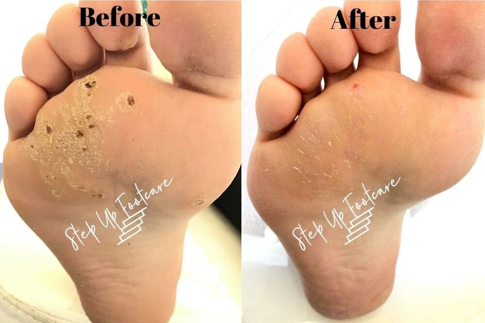 wart on the foot removal