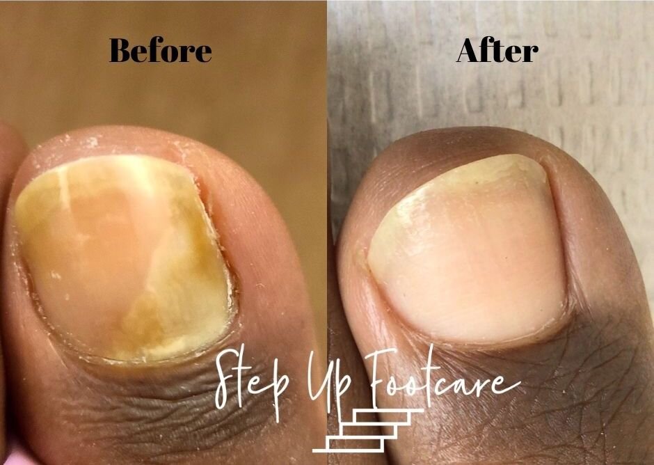 Fungal Nail Infection - How To Treat? - The Healthcare Hub - Cardiff