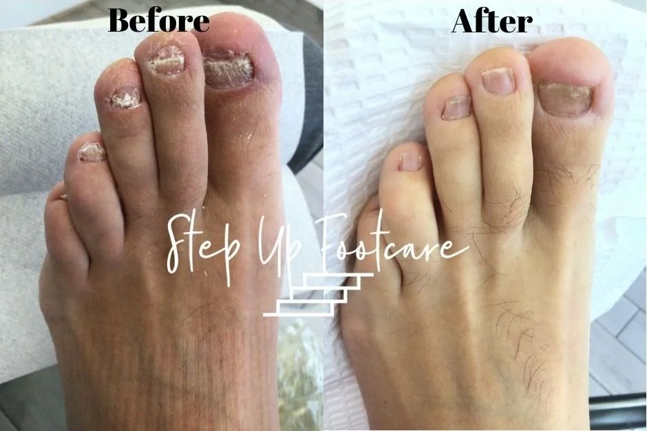 Laser Toenail Fungus Treatment Podiatrist NYC Downtown Step Up Footcare