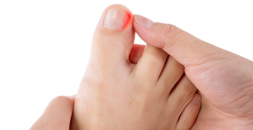 Pincer Nail Deformity: Clinical Characteristics, Causes, and Managements