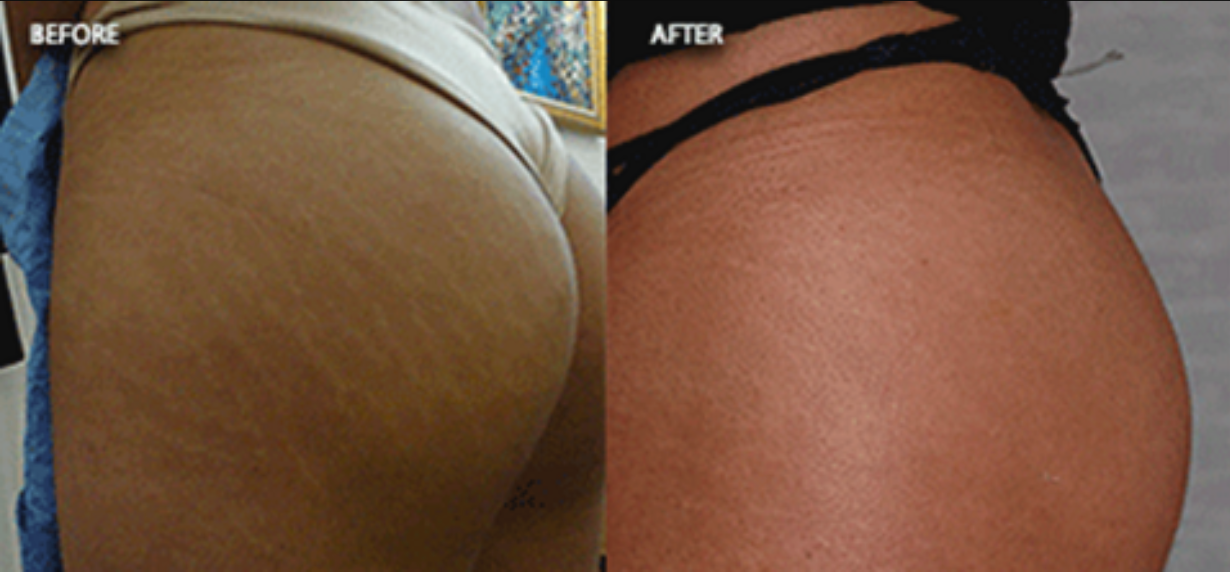 Carboxytherapy_Detail_01.png