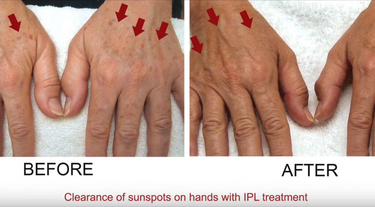 IPLPhotofacial_Detail_02.png