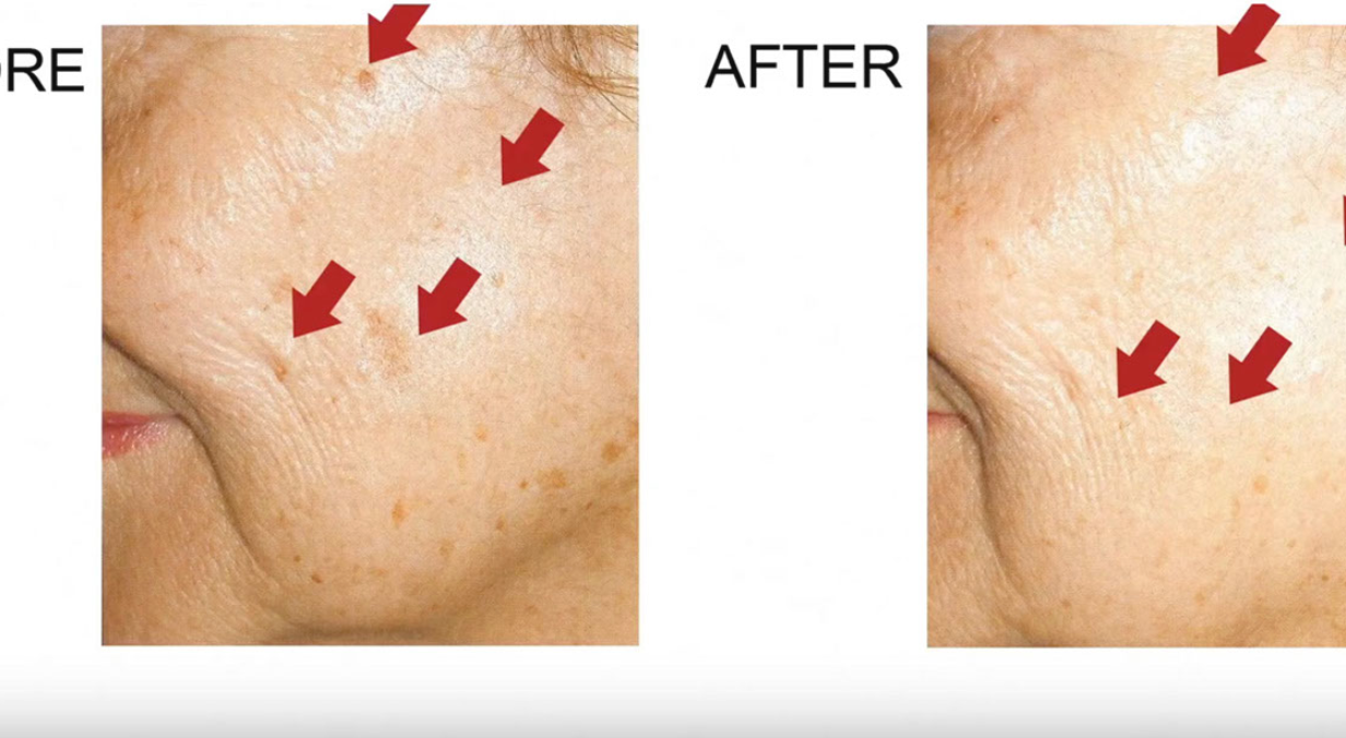 IPLPhotofacial_Detail_03.png