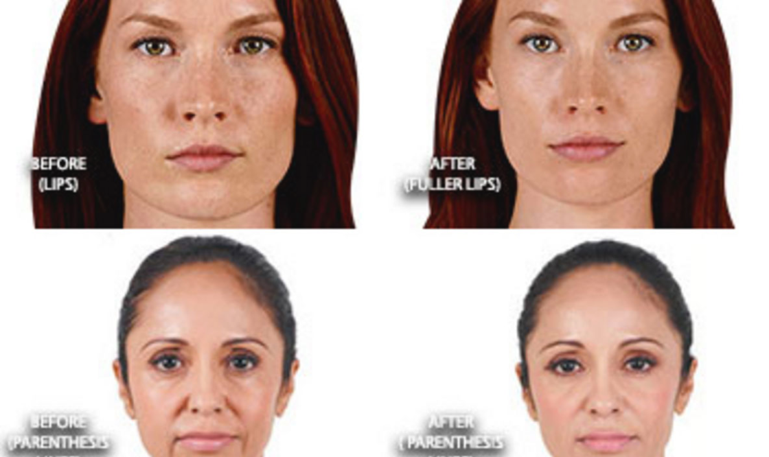 Juvederm_Detail_01.png