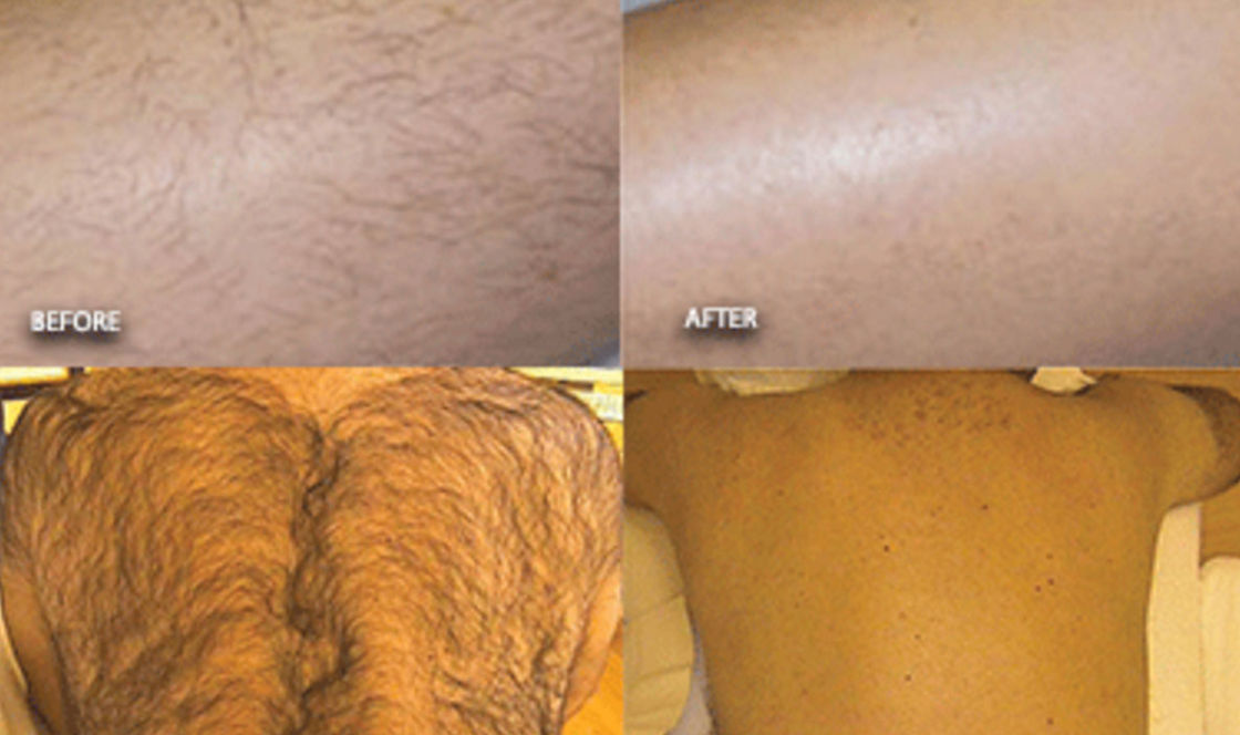 LaserHairRemovail_Detail_02.png