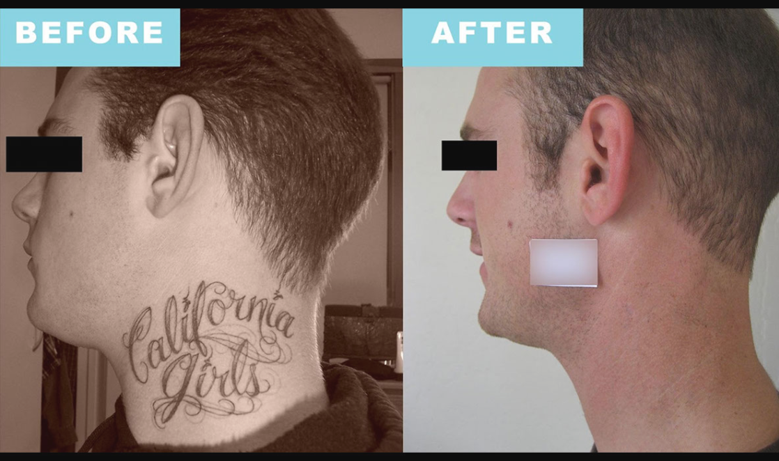 LaserTattooRemovail_Detail_01.png