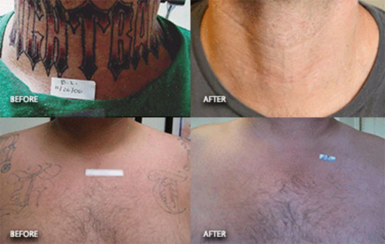 tattooremoval_thumbnail_small.jpg