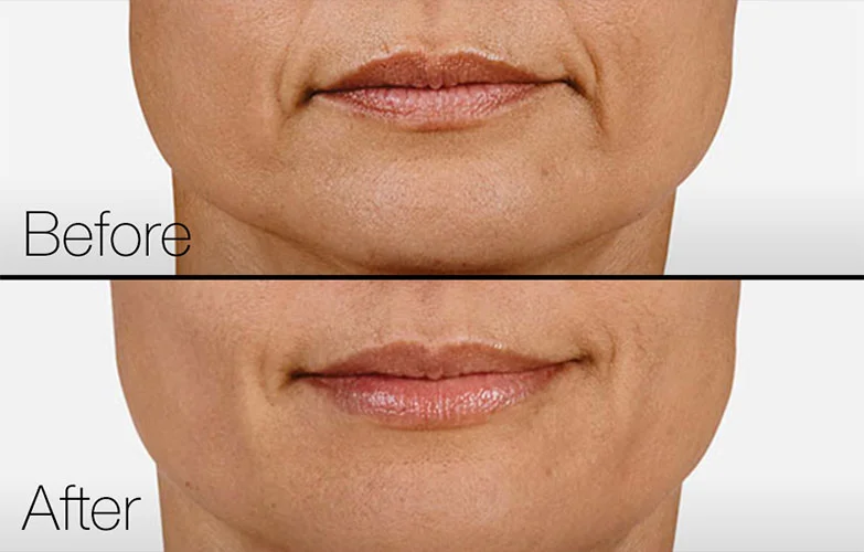 thinlips_thumbnail_small.jpg