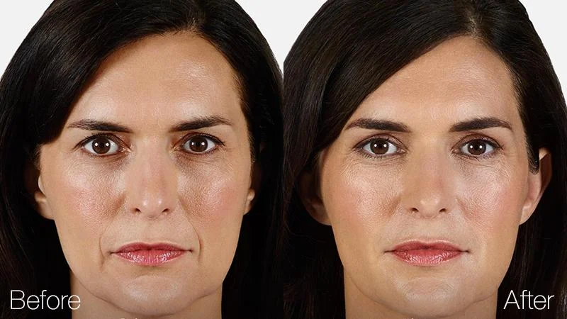 Juvederm_01.jpg