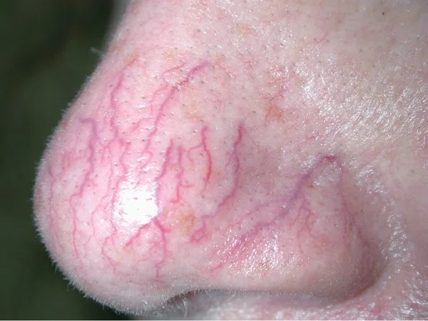 facialvein_01_B.jpg