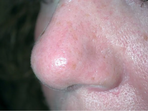 facialvein_01_A.jpg