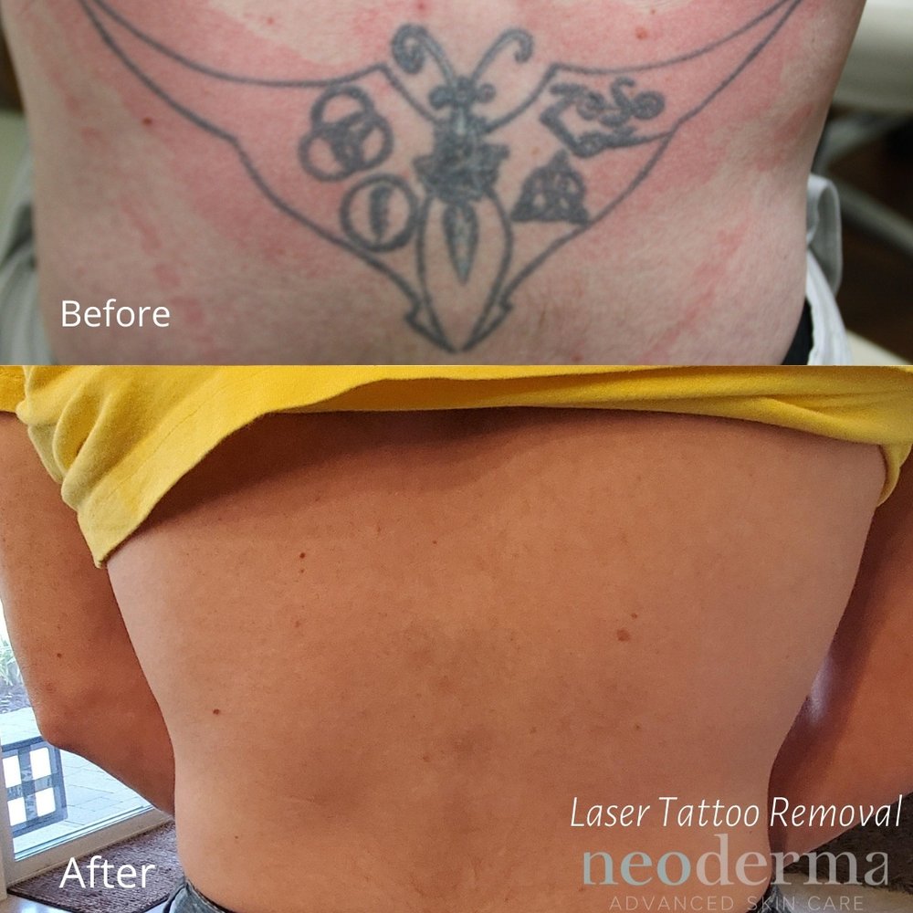 Laser Tattoo Removal — Neoderma Advanced Skin Care