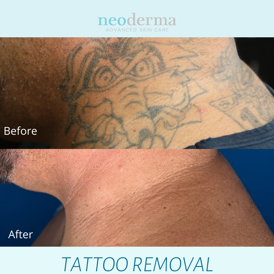 Laser Tattoo Removal — Neoderma Advanced Skin Care