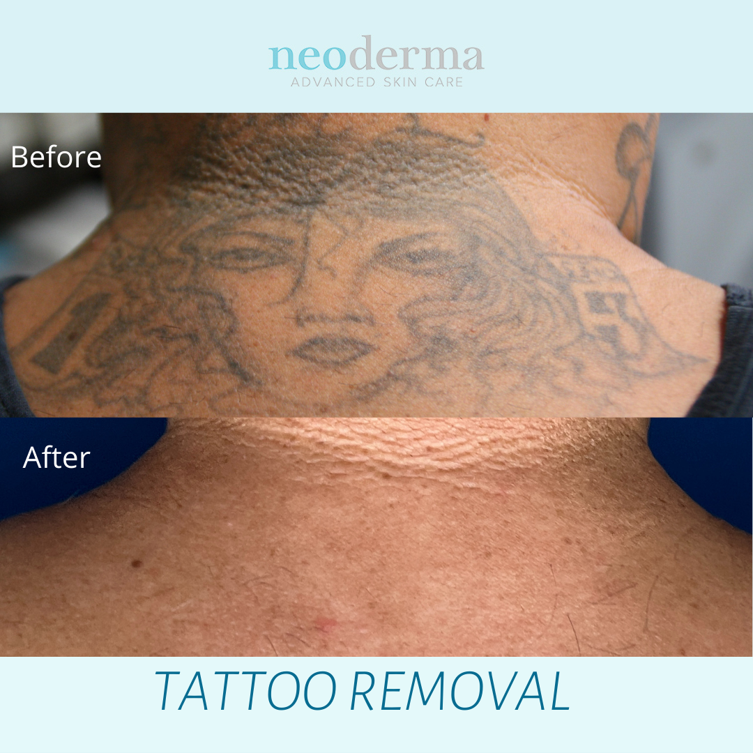 Tattooremoval Patch Offers Tatilizing Results  Cosmetics  Toiletries