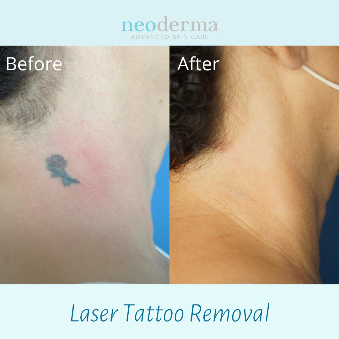 How does laser tattoo removal work? | Goodbye Tattoos