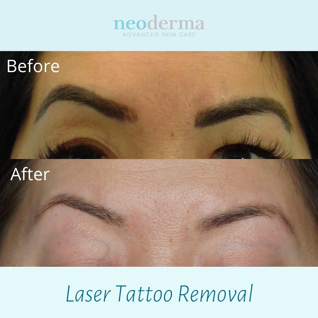 Eyebrow+Laser+Tattoo+Removal