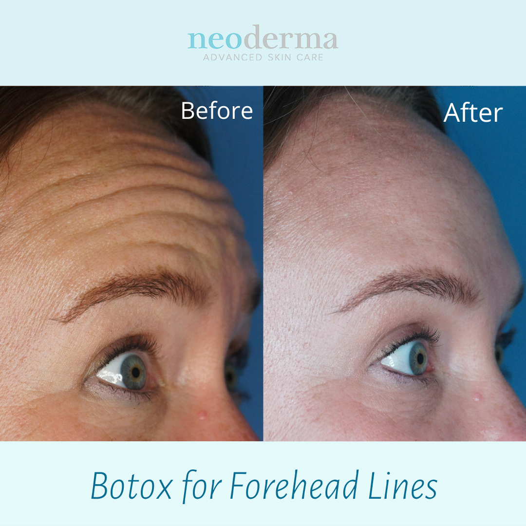 Botox Before And After Forehead Lines