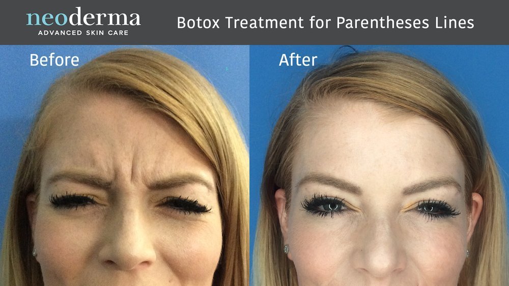 Before and After Botox.jpg