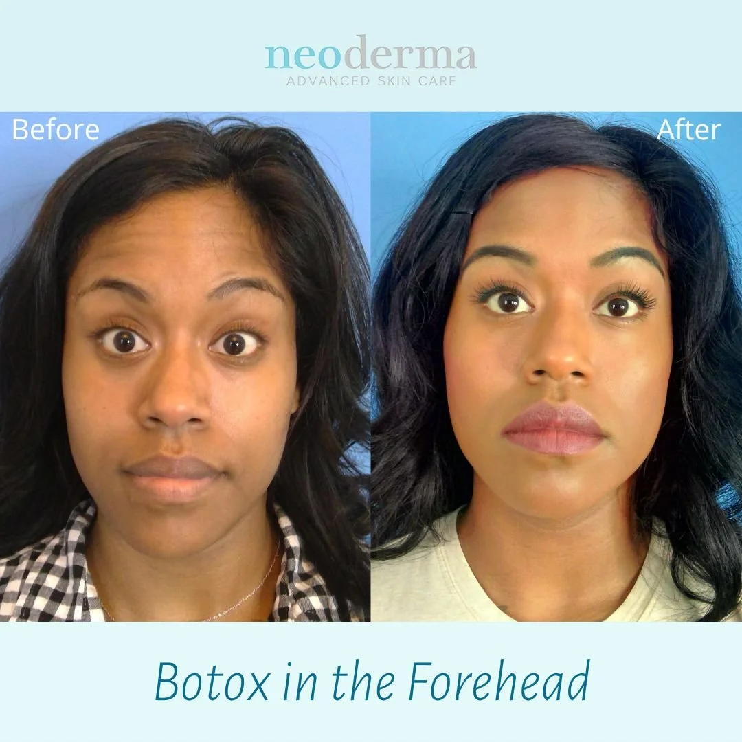 Botox Gone Wrong Forehead