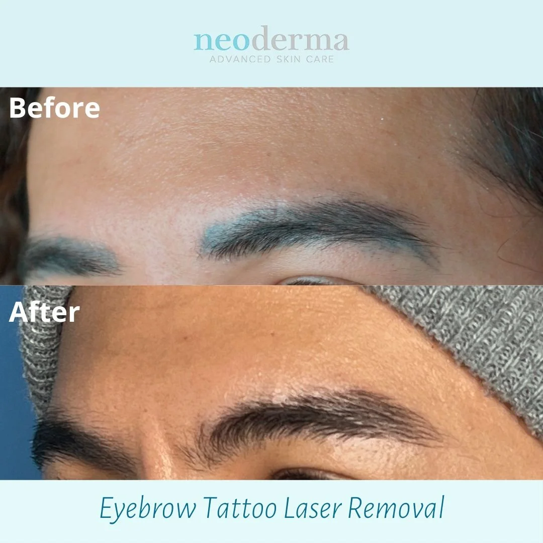 alt="Eyebrow tattoo removal using PicoWay laser at Neoderma Medspa in Anaheim"  alt="Before and after PicoWay eyebrow tattoo removal session"