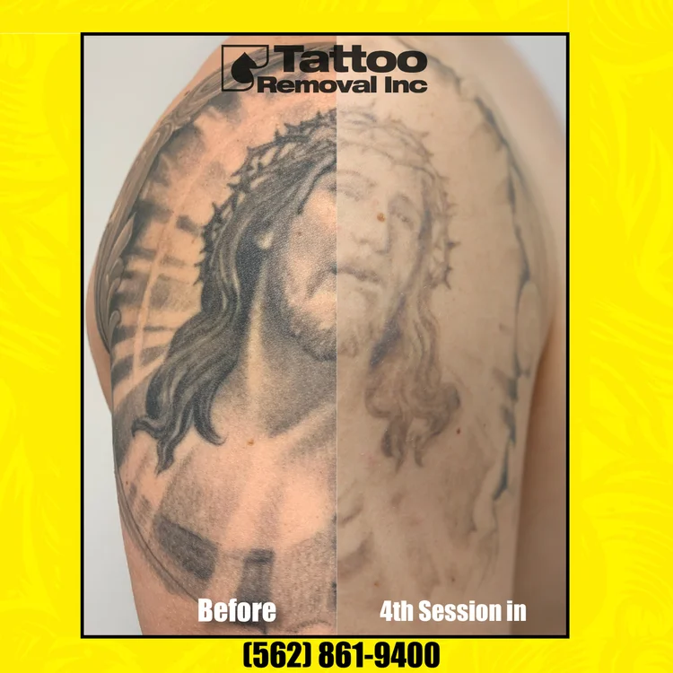 Tattoo Removal Inc