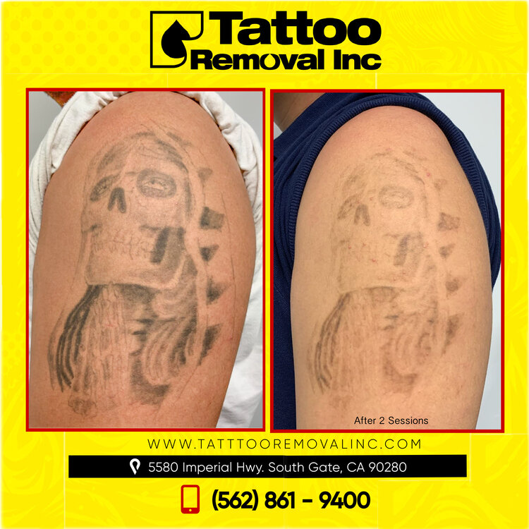 Tattoo Removal Inc