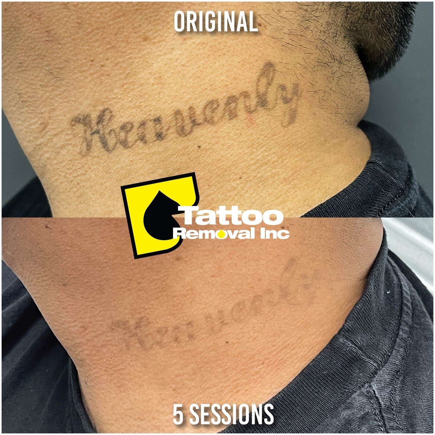 Say Goodbye to Your Unwanted Ink. Session by Session patience is key 🔑 as well as keeping with aftercare
Number of treatments depends on the age and ink type of your tattoo to determine how long it'll take to remove
*Treatment Results Vary Per Indiv