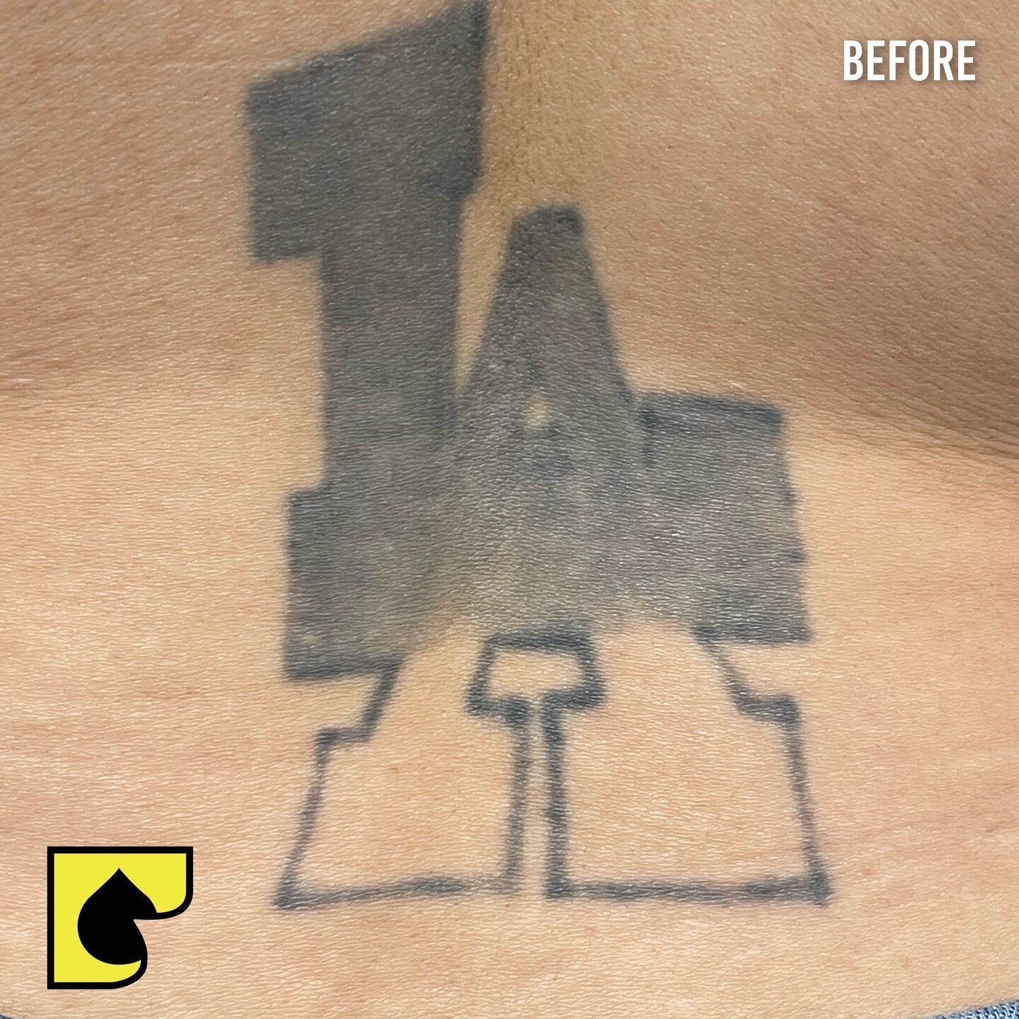 Tattoo Regrets? Remove your unwanted tattoos, big or small....
Call us today ☎️ (562) 861-9400 📞
*Treatment Results Vary Per Individual 

#unfilteredphotos #BeforeAndAfterTattooRemoval #BackLA #TattooRemovalIncSouthGate #BackTattooRemoval #SouthGate