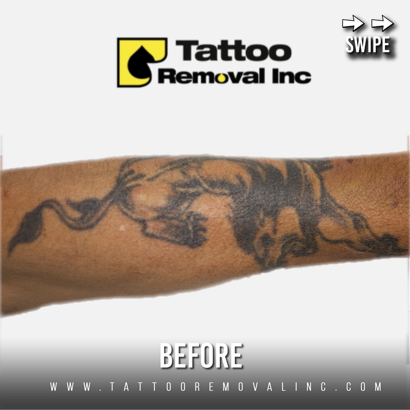 Remembering when they started on their tattoo removal journey to the almost end of the journey
Thank you for your trust 🙏 contact us for any of your tattoo removal needs!

*All results may vary per individual and photos are unfiltered
#unfilteredpho