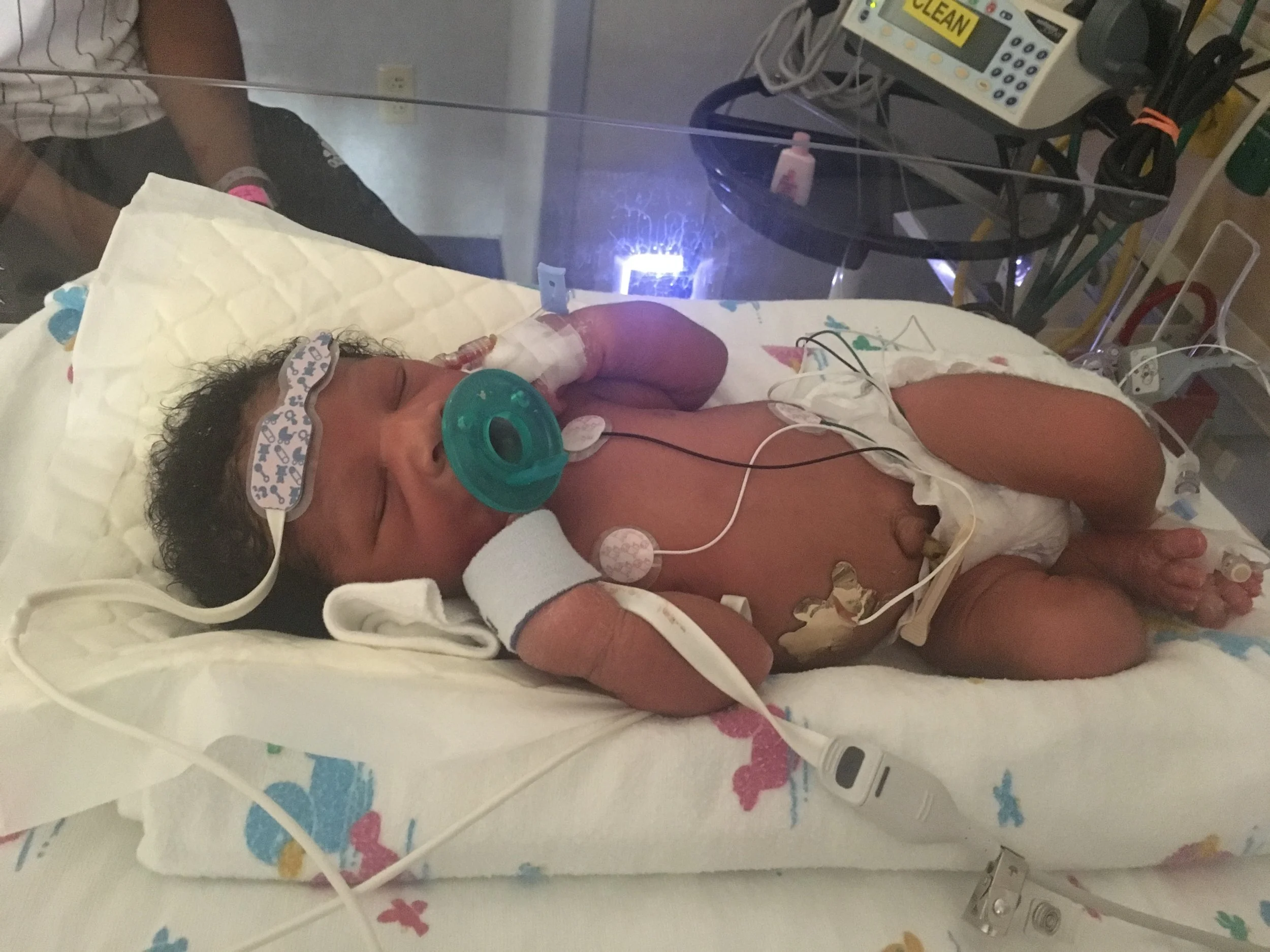 CCHD (Critical Congenital Heart Defects)