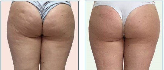 Cellulite Butt 1.jpg