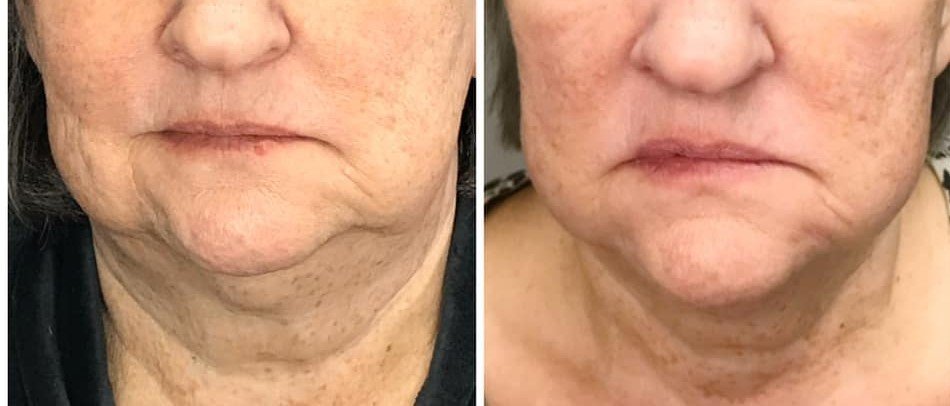 jowl and neck lift 12 weeks.jpg