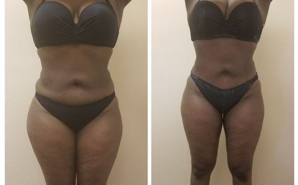 What Non-Surgical Body Contouring Really Does (And What It Doesn’t)