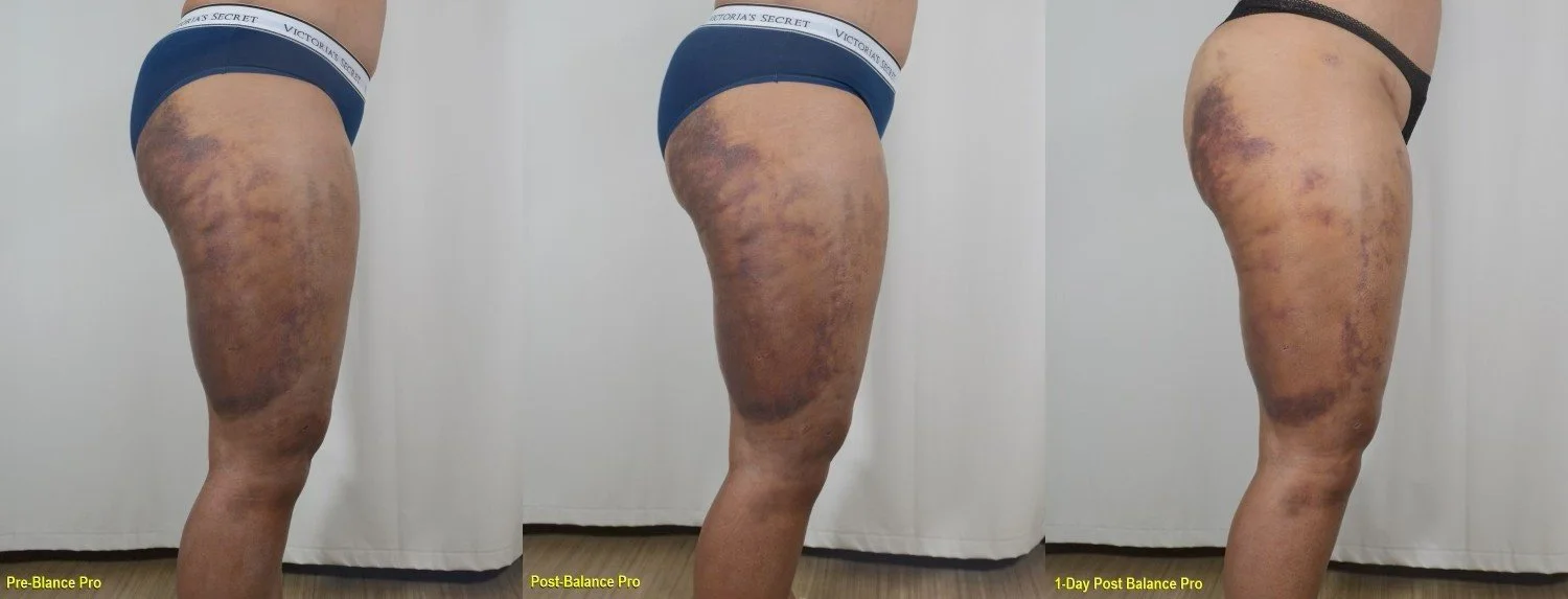 Post lipo BallancerPro lymphatic drainage