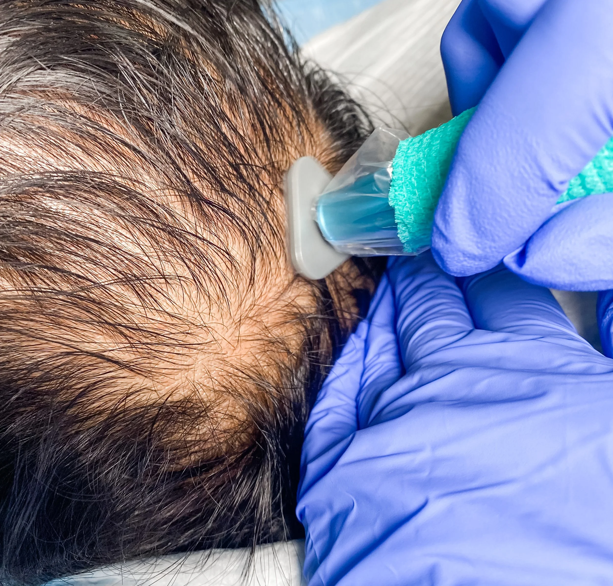 Hair follicle stimulation scalp therapy treatment  Non-invasive hair follicle activation therapy  Scalp treatment to stimulate hair growth  Healthy hair follicles after stimulation therapy