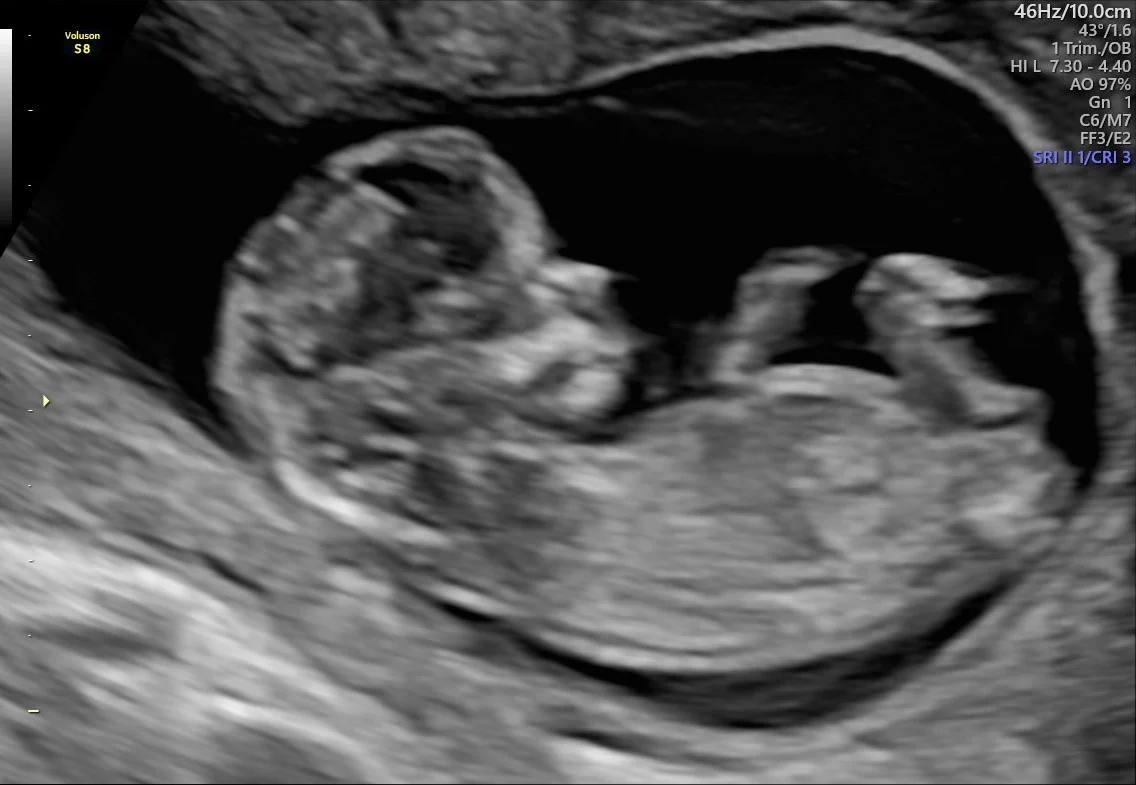 Gravid Uke 12 Tidlig Ultralyd Oslo Familien No