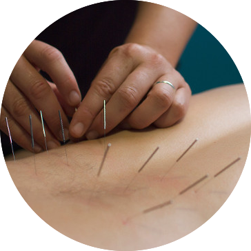 Dry-Needling.png