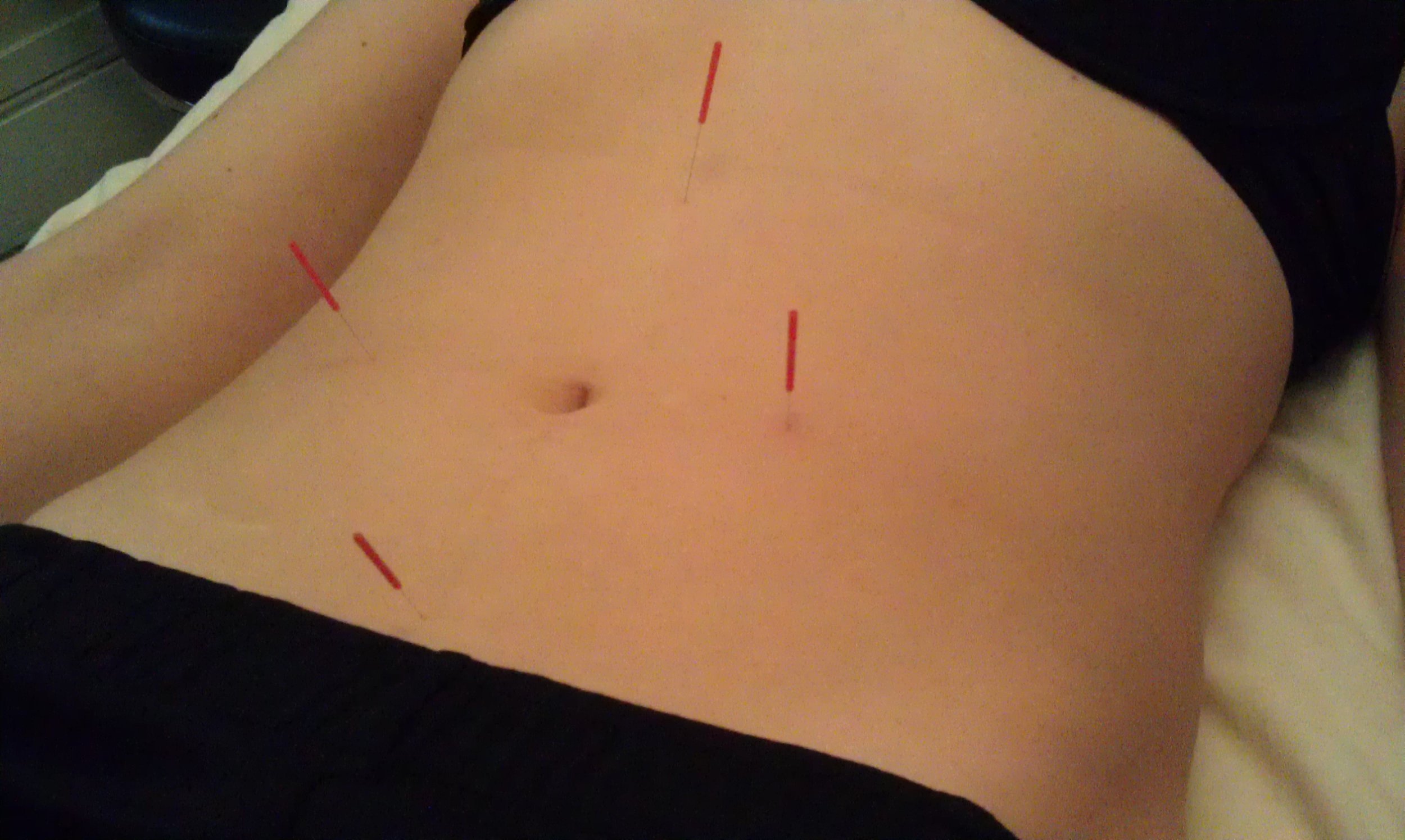 The Difference Between Chinese Medicine, Acupuncture, and Dry Needling