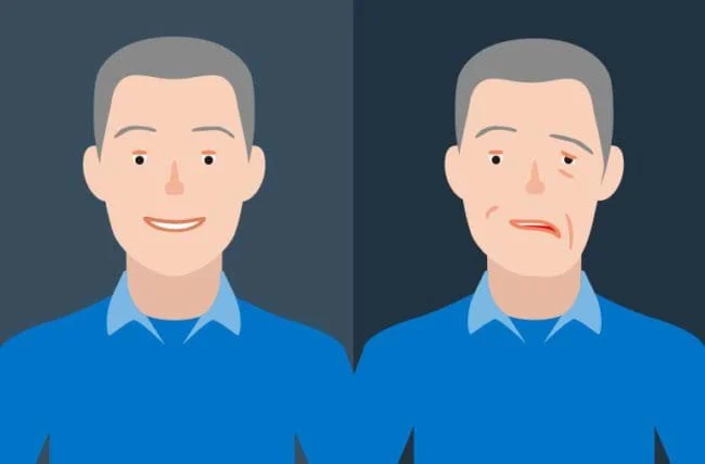 Acupuncture for Shingles, Bell's palsy and Neuropathy