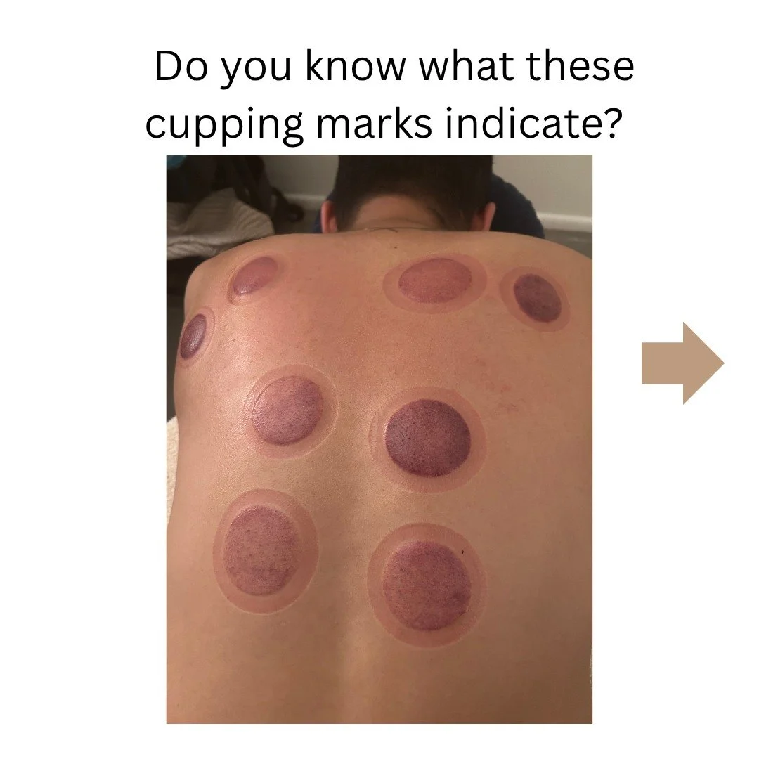 Cupping therapy is an ancient Chinese Medicine therapy in which a cup is applied to the skin and the pressure in the cup is reduced (either by heat or suction) in order to draw and hold skin and superficial muscles inside the cup. Cupping therapy is 
