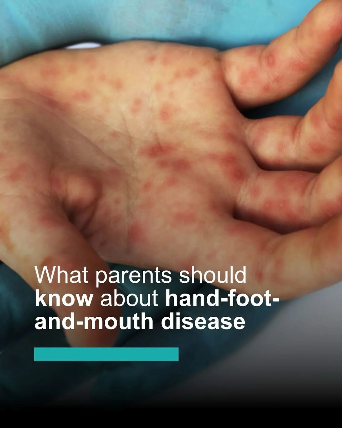 Hand, foot, and mouth disease is a common viral illness&mdash;most often caused by Coxsackievirus A16. It&rsquo;s typically seen in young children, but it can affect people of all ages.
Common symptoms include small sores in the mouth along with a ra