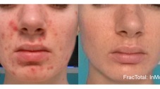 before and after of acne and scar reduction with the use of Fractora treatment yorktown heights ny